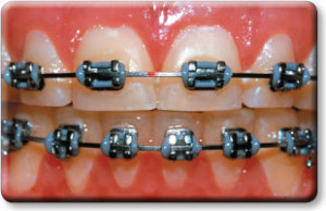 Metal Braces With Elastics